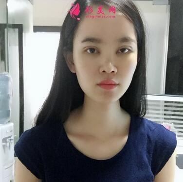 重庆市中山医院整形美容科价格表,附隆鼻案例效果对比图