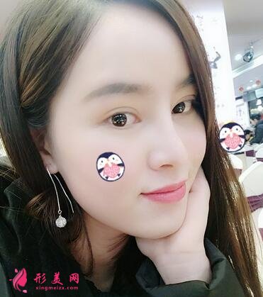 重庆市中山医院整形美容科价格表,附隆鼻案例效果对比图