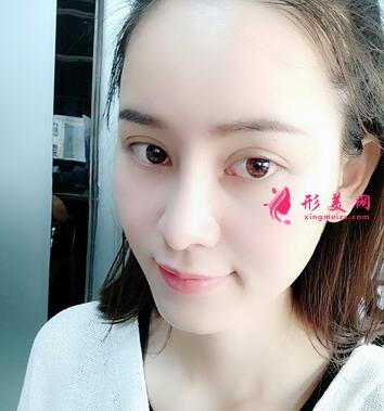 重庆市中山医院整形美容科价格表,附隆鼻案例效果对比图