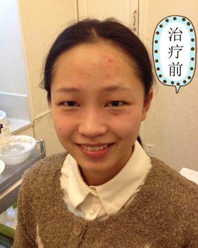 有人做过光子嫩肤吗?自己做过,感觉效果不错分享