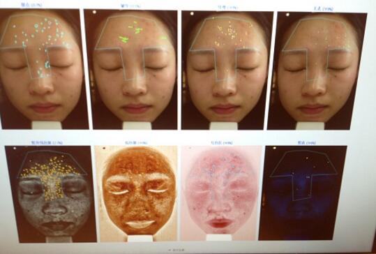 有人做过光子嫩肤吗?自己做过,感觉效果不错分享