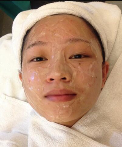 有人做过光子嫩肤吗?自己做过,感觉效果不错分享