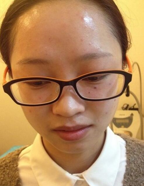 有人做过光子嫩肤吗?自己做过,感觉效果不错分享