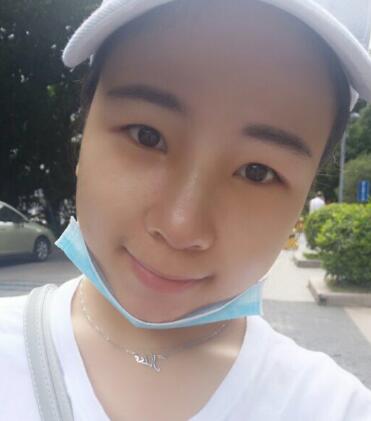 在宁波尚美医院做的鼻子综合整形效果不错