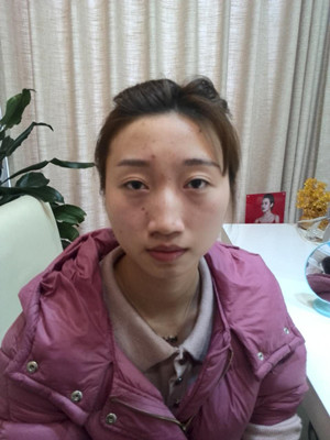 潍坊华美童艳梅医生做的面部脂肪填充，大家来看看效果怎么样