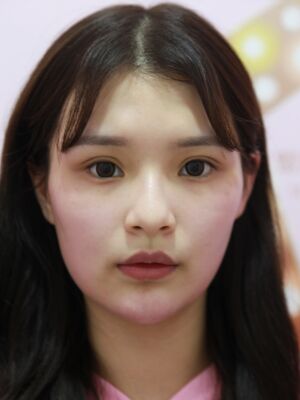 线雕隆鼻效果好不好，长沙希美真是案例告诉你