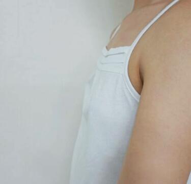 自体脂肪隆胸对比图和恢复过程分享,手感真实