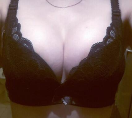 自体脂肪隆胸对比图和恢复过程分享,手感真实