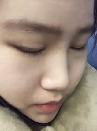 成都美未央鼻综合手术恢复日记图