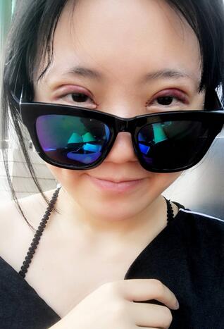 成都美未央双眼皮恢复过程日记