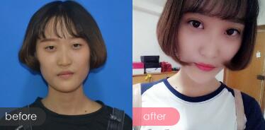 切开双眼皮多少钱?割双眼皮真实案例多对比图分享