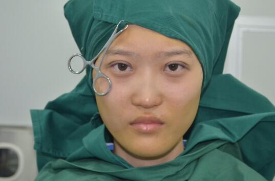 切开双眼皮多少钱?割双眼皮真实案例多对比图分享