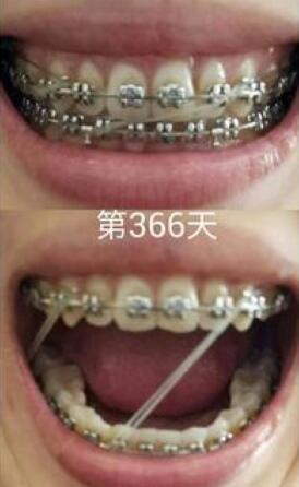 牙齿矫正前后对比图,成人牙齿矫正费用9800元——成都格林口腔医院