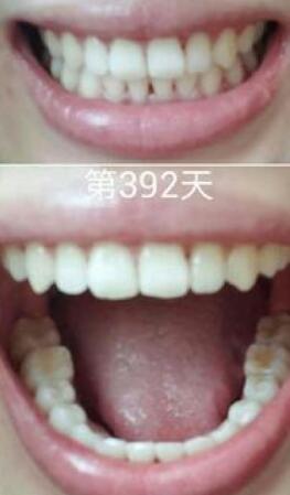 牙齿矫正前后对比图,成人牙齿矫正费用9800元——成都格林口腔医院