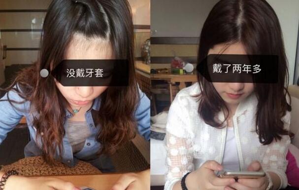 成都牙齿矫正前后对比图分享——成都格林口腔