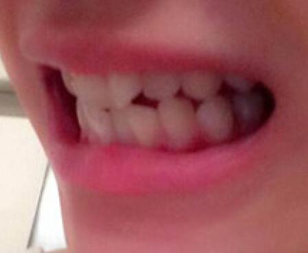 成都矫正牙齿案例分享——成都格林口腔医院