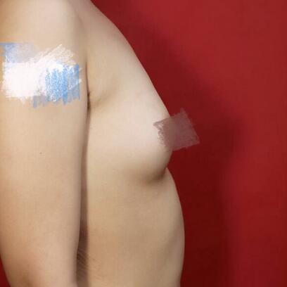 上海九院余力自体脂肪隆胸一年