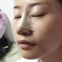 假体隆鼻恢复时间2个月真实案例分享——成都魅丽经纬