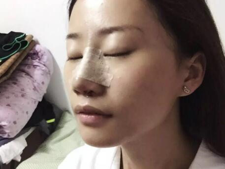 假体隆鼻前后对比图,假体隆鼻恢复时间2个月真实案例