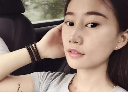 假体隆鼻前后对比图,假体隆鼻恢复时间2个月真实案例