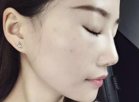 假体隆鼻前后对比图,假体隆鼻恢复时间2个月真实案例