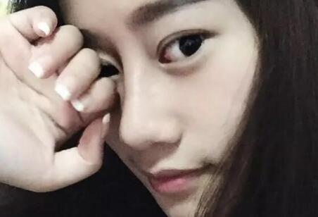 假体隆鼻前后对比图,假体隆鼻恢复时间2个月真实案例