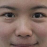 歪鼻子矫正整形恢复过程和对比图分享——成都魅丽经纬医疗