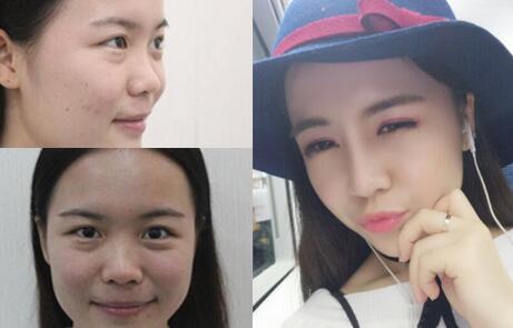 隆鼻整形前后对比图,歪鼻子矫正整形恢复过程