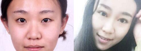 双眼皮切割前后对比图,单眼皮变双眼皮整形恢复过程