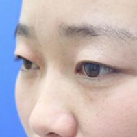 割双眼皮前后对比图和恢复过程——成都魅丽经纬整形医院