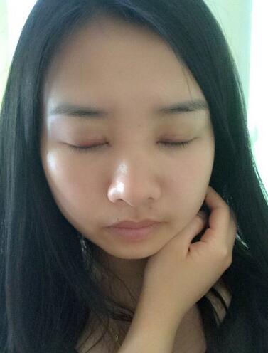 武汉乐美韩式微创双眼皮+开内眼角