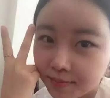 双眼皮整形前后对比图，单眼皮变双眼皮整容日记