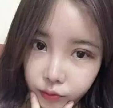 双眼皮整形前后对比图，单眼皮变双眼皮整容日记