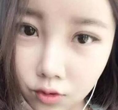 双眼皮整形前后对比图，单眼皮变双眼皮整容日记