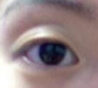 厦门割双眼皮+开眼角整形过程恢复对比图——安黛美整形医院