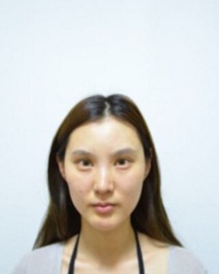 全面部自体脂肪填充恢复照片，北京京美真实案例