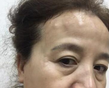 去抬头纹最好的方法?肉毒素去抬头纹鱼尾纹