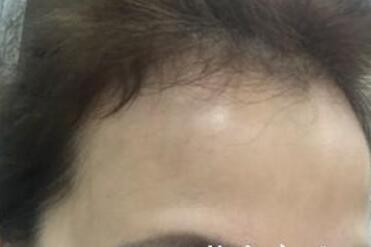 去抬头纹最好的方法?肉毒素去抬头纹鱼尾纹