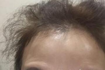 去抬头纹最好的方法?肉毒素去抬头纹鱼尾纹