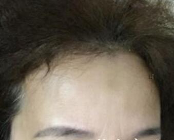 去抬头纹最好的方法?肉毒素去抬头纹鱼尾纹