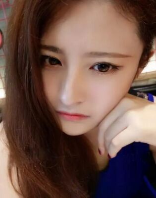 深圳易容颜全切双眼皮后恢复过程图