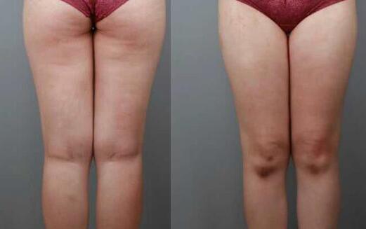 吸脂减肥瘦大腿前后对比图,光纤溶脂瘦大腿最有效的方法真实案例