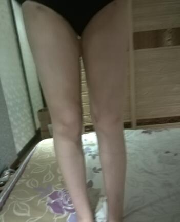 吸脂瘦大腿前后对比图，水动力吸脂瘦大腿真实案例多对比图经历