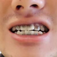 牙齿排列不整齐，在成都圣贝牙科医院做了牙齿正畸矫正治疗