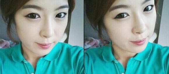 武汉艺龄整形医院做驼峰鼻矫正价格12k,真实案例恢复过程图