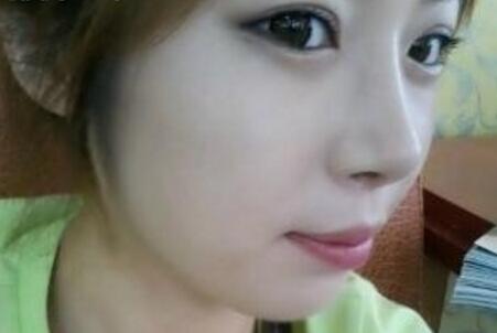 武汉艺龄整形医院做驼峰鼻矫正价格12k,真实案例恢复过程图