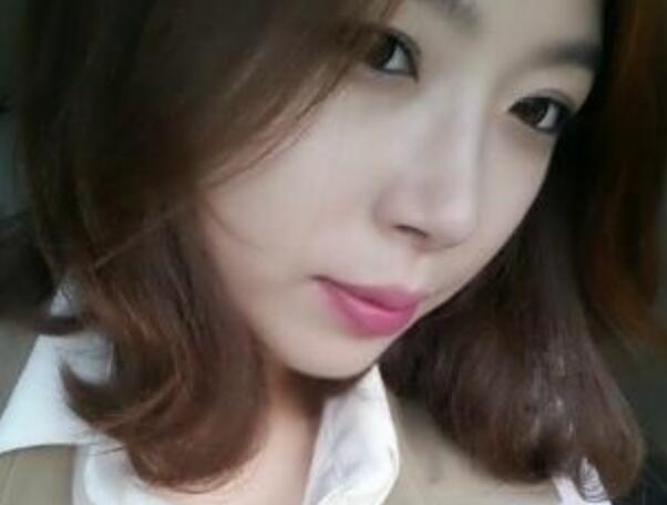 武汉艺龄整形医院做驼峰鼻矫正价格12k,真实案例恢复过程图