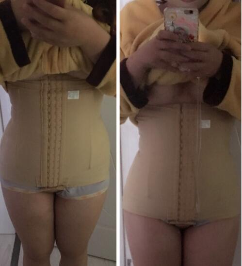 抽脂减肥瘦腰腹手术价格,真实案例前后对比图