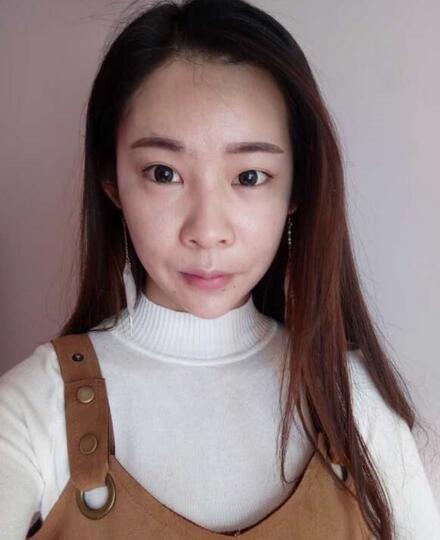 北京医院钱文江切开双眼皮恢复过程