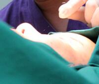 时光整形医院做的割双眼皮手术价格5200元 双眼皮对比图恢复过程